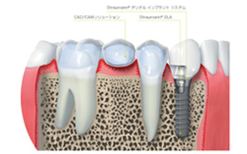 インプラント治療について