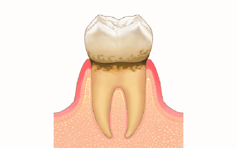 軽度歯周炎
