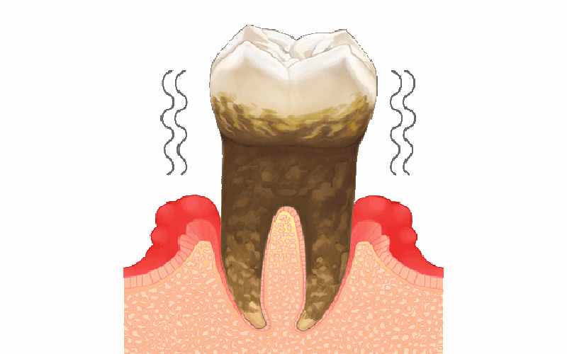 重度歯周炎